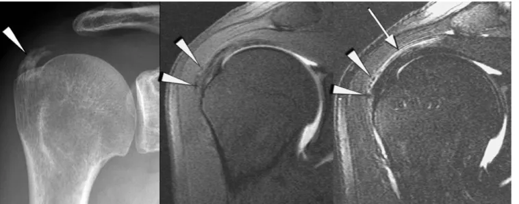 Fig. 3 52-year-old man with a true positive calcific tendinitis of the supraspinatus tendon: The anteroposterior radiograph (left image) demonstrates longitudinal calcific deposit (arrowheads)