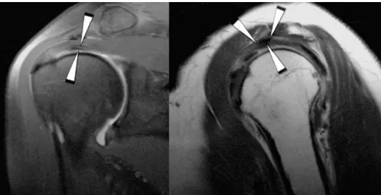 Fig. 6 41-year-old woman with a false positive result: A focal area of hypointensity  (arrow-heads) is seen at anterior aspect of supraspinatus tendon  sub-stance on all sequences [coronal oblique intermediate-weighed fat-saturated (2350/13) (left image) a