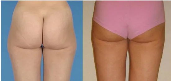 Fig. 2 Result before/after lipo- lipo-suction at lipodysmorphy