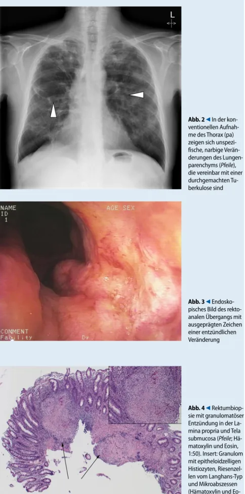 Abb. 3  9  Endosko- Endosko-pisches Bild des  rekto-analen Übergangs mit  ausgeprägten Zeichen  einer entzündlichen  Veränderung