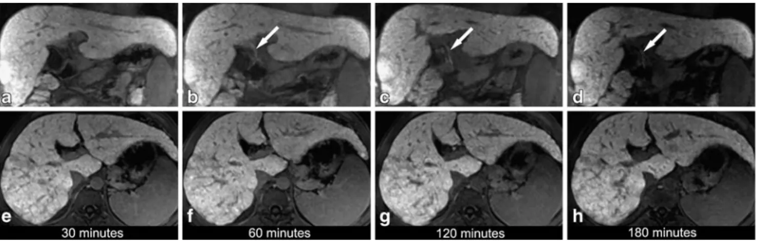 Fig. 4 Coronal (a) and transaxial (b) fat-suppressed 3D T1- T1-weighted GRE images (3.1/1.4, 15° flip angle) obtained 180 min following Gd-EOB-DTPA administration in a 55-year-old male patient with histologically proven liver cirrhosis and decreased liver