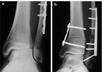 Fig. 4 Drawing of lateral malleolar lengthening osteotomy: removal of scar tissue between the medial malleolus and talus, osteotomy of the fibula, lengthening with distraction device, and grafting