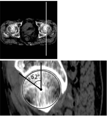 Fig. 4 CT measurement of anterior acetabular coverage in the sagittal plane. Measurements of the anterior acetabular coverage on CT scans, was performed by using a sagittal plane CT reformations through the center of the femoral head