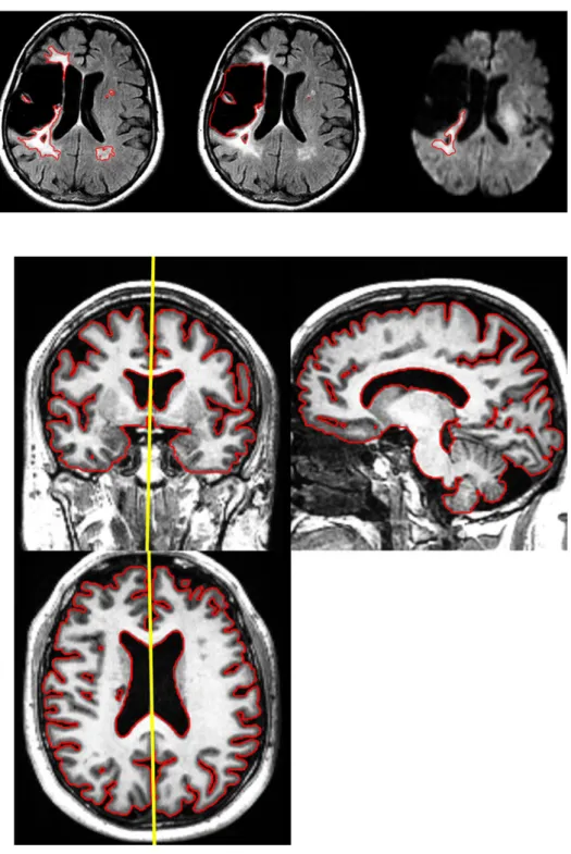 Fig. 3 Brain parenchyma detection. Brain parenchyma contours (in red) was  pre-detected using a 3D segmentation algorithm on 3DT1 images by 3D deformable registration of a brain atlas, after skull removal, and manually validated prior to submission to the 