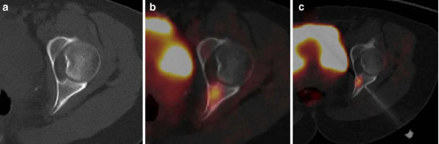 Fig. 1 PET-CT-guided biopsy of a bone lesion not visible in CT.