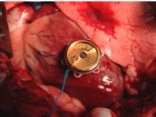 FIGURE 5. The prototype generator sewn (blue threads) onto the sheep’s heart using three eyelets of the housing.