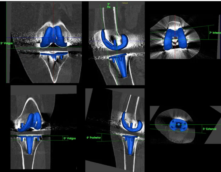 Fig. 2 Determination of tibial and femoral total knee arthroplasty (TKA) component position (varus – valgus, flexion – extension, internal rotation–external rotation) on 3D-CT using customised software after