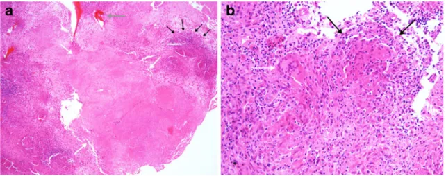 Fig. 2 Haematoxylin and eosin stained sections of the bone biopsy showing granulomatous osteomyelitis typically seen in tuberculous osteomyelitis