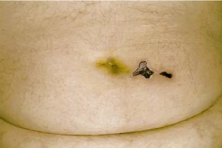 Fig. 1 Peri-umbilical skin necrosis (approximately 3 cm in diameter) at the site of LMWH administration