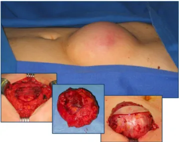 Fig. 3 Brachytherapy of desmoid tumors before (left) and 2 years after brachytherapy (right)