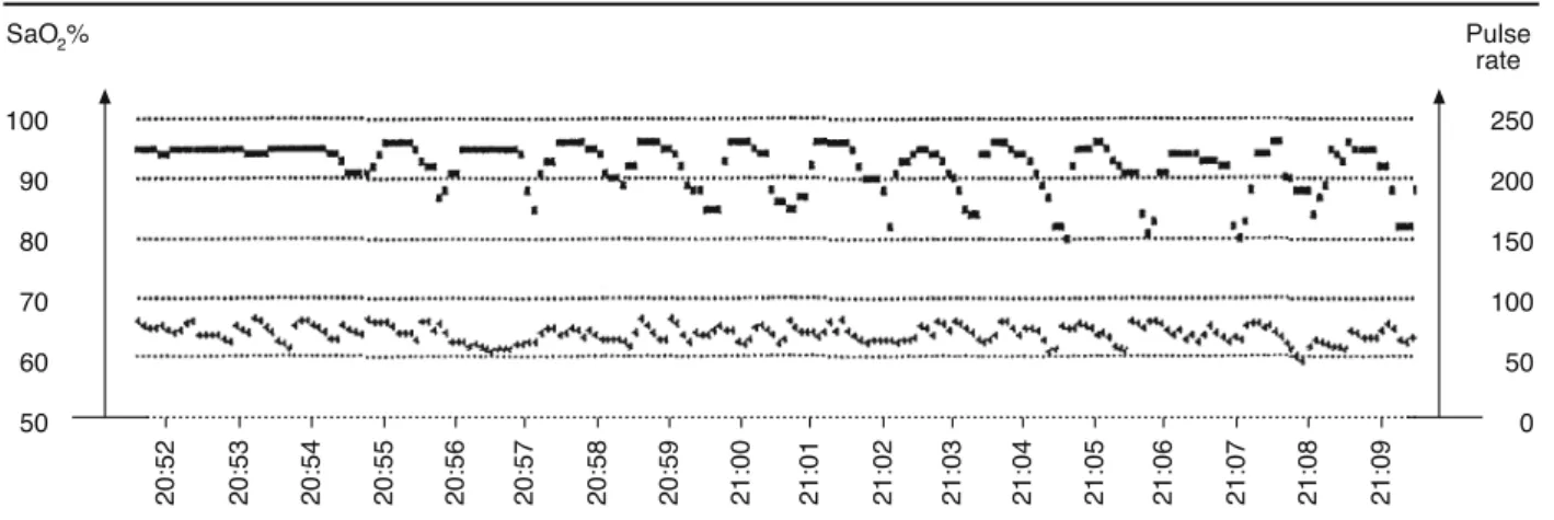 Figure 7 - Pulse-oximetry tracing of a 75-year-old male subject with OSA. Upper tracing shows oxygen saturation (SaO 2 ); lower  tracing shows heart rate