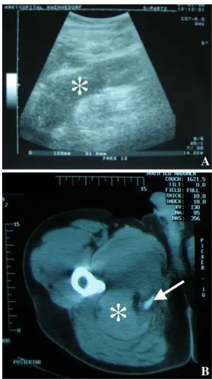Fig. 1 Initial diagnostic findings in a 48-year-old man with avulsion of the hamstring muscle group and initial ischial palsy caused by a huge hematoma in the posterior compartment of the right limb