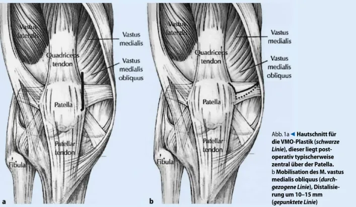 Abb. 1a  9  Hautschnitt für  die VMO-Plas tik (schwar ze  Li nie), die ser liegt  post-opera tiv  ty pi scher wei se  zent ral über der Pa tel la