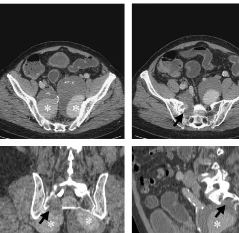 Fig. Multi-slice CT scan after IV iodinated contrast material injection. Axial transverse image (top) showing bi- bi-lateral partially thrombosed giant internal iliac artery aneurysms (  ), the left one with a 6.7cm diameter and a 4.2cm thrombus, and the r