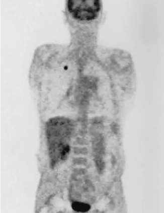Fig. 1 Coronal positron emission tomography (PET) image in case 1: pathological 2-[F-18]-fluoro-2-deoxy-D-glucose (FDG) accumulation in the right apical lung is seen