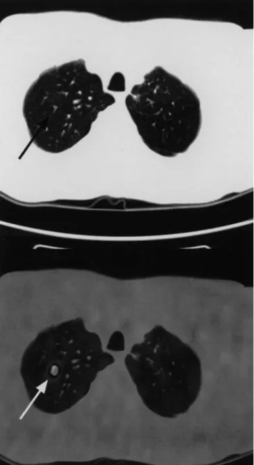Fig. 4 Partially paravenous injection in the right arm in case 1