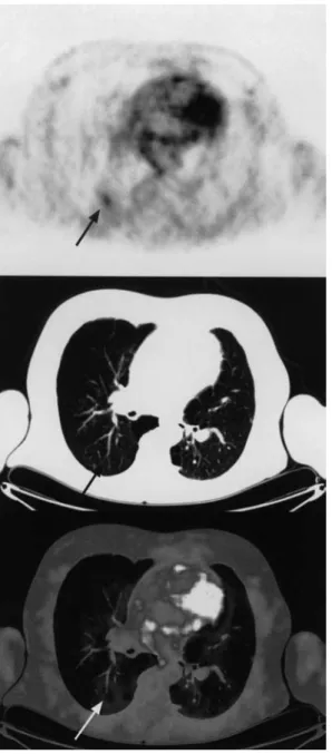 Fig. 6 Case 2 with FDG accumulation in the right lung without anatomic correlate (arrows)