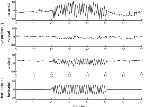 FIG. 1. Three-dimensional position traces (upper three panels: horizontal, vertical, torsional) of the right eye in an upright sitting patient (P.I.) with a right-sided peripheral vestibular deficit