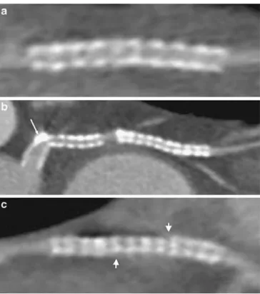 Fig. 1 Three examples of artifact types deteriorating image quality of coronary artery stents with 64-slice CT using curved multiplanar reconstruction along the stent-axis