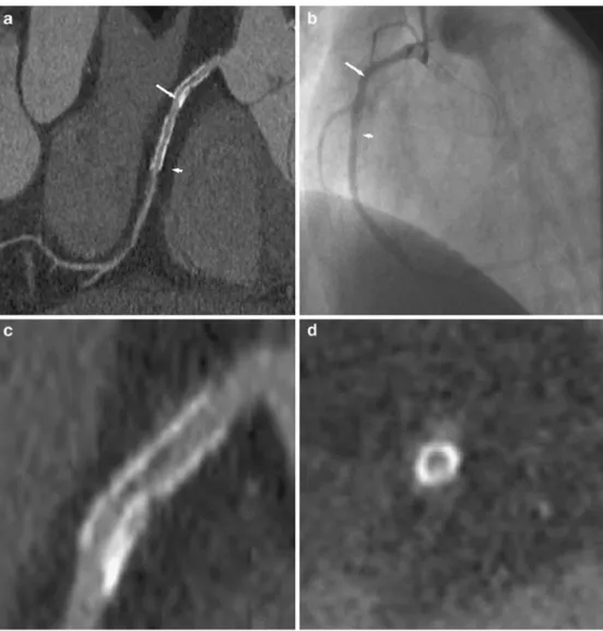 Fig. 3 Two AVE stents in the right coronary artery  demon-strated with 64-slice CT using (a) curved multiplanar  recon-struction along the vessel, and (b) by conventional coronary angiography