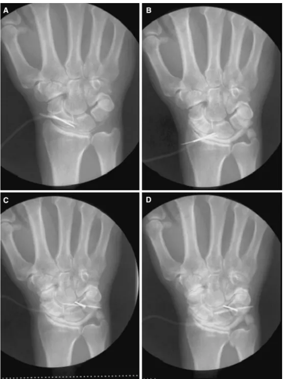 Fig. 3 Images obtained during arthrography. Early and complete ﬁlling of the