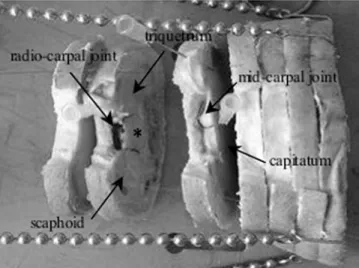 Fig. 5 Anatomical dissection of the wrist. Dissection of the wrist allows emptying the radiocarpal and midcarpal joint