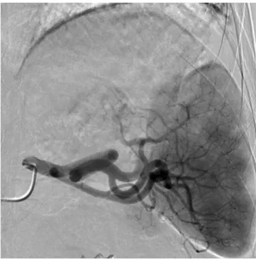 Fig. 5. Post-embolization angiography showing occlusion of the superomedial splenic artery and devascularization of the upper spleen