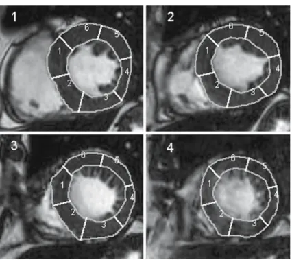 Fig. 1 LV myocardium segmentation starting from the anterior junction of the RV with the LV, and propagation of the heart orientation through the stack of images covering the LV long axis