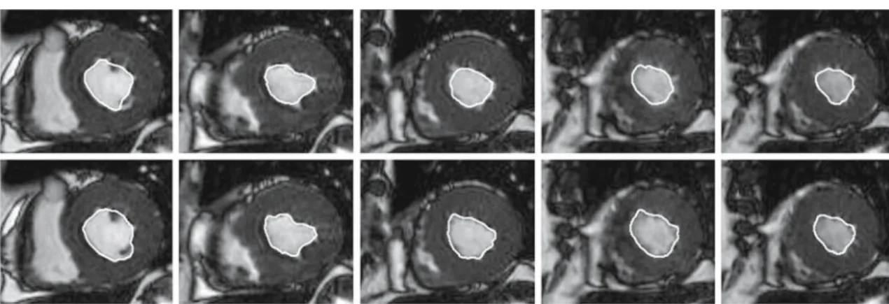 Fig. 3 Example of endocardial segmentation at the end systolic phase through the LV long-axis (columns) with the traditional model (first row) and the pressure forces-based model (second row)