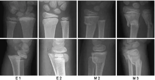 Figure 1. Definition of the metaphysis.