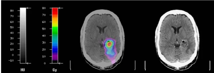 Fig. 3 Quantitative voxelwise dose map in a patient with glioblastoma multiforme documenting an orthotopic dose distribution