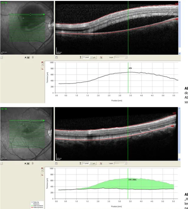 Abb. 2  8  Netzhautdicke („retinal thickness“, RT) vor und nach „Half-dose-  Netzhautdicke („retinal thickness“, RT) vor und nach „Half-dose-PDT“
