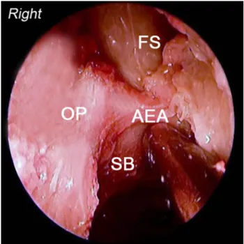 Fig. 1 Right anterior skull base. OP orbital periosteum, FS frontal si- si-nus, AEA anterior ethmoidal artery, SB anterior skull base