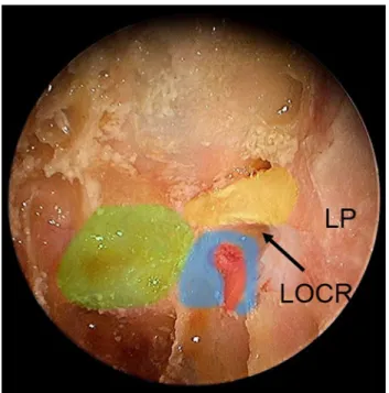 Fig. 5 Plastinated skull model showing the right optic strut. ON optic nerve (yellow), ICA internal carotid artery (red)