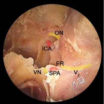 Fig. 8 Right petrous apex. ICA internal carotid artery, VN vidian nerve, SS sphenoid sinus, ST sella, R rostrum, VI abducens nerve, V2 maxillary nerve