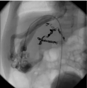 Fig. 4. A selective angiogram of the cavernous part of the he- he-mangioma showing three main draining veins into the dilated liver veins
