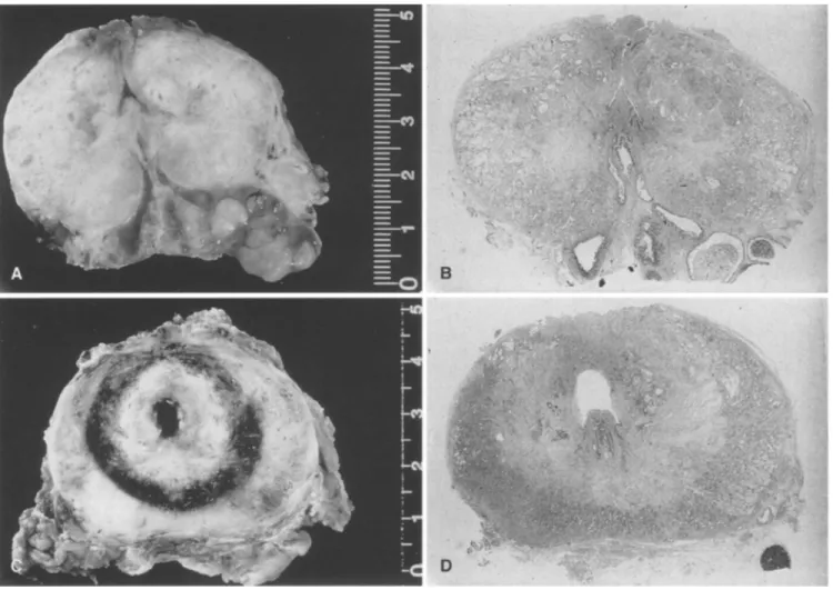 Fig. 1A-D  Macroscopic  view of human prostate  after  VLAP pro-  cedure  (horizontal  section,  native  and  H  &amp;  E-stained) at  210 rain  (A, B) and at 4 days (C, D) following a 40-W/90-s power  setting 