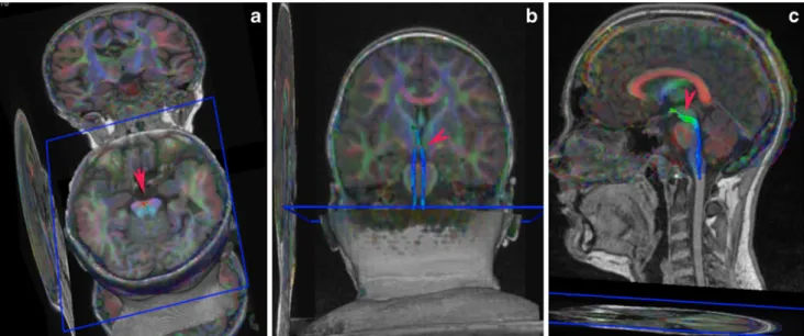 Fig. 5 This sagittal image shows the spatial relationship between the VTD (red arrowhead) and SCP (green arrowhead) in the isthmic region; note that the VTD is situated slightly cranial to SCP tracts