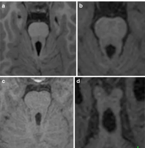 Fig. 7 a FT of the cerebello- cerebello-rubro-thalamic tract in patient 4.