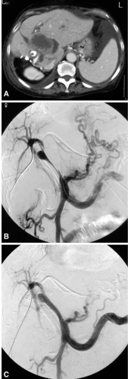 Fig. 2 A 77-year-old woman with liver metastasis from colonic adenocarcinoma leading to biliary malignant obstruction treated via the retrograde endoscopic route 3 months ago (patient 7)