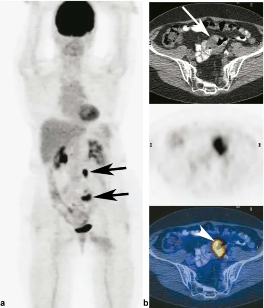 Fig. 2 A 70-year-old female patient with high-risk  melano-ma and elevated S-100B (0.8 μ g/l)