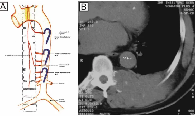 Fig. 1 The three sizes of the Berner Spinalkatheter. A Depending on the aortic diameter, one of three catheter sizes is chosen in order to get an optimal stability during the intervention