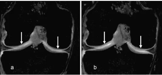 Table 2 Semiquantitative data for each joint compartment regarding surface visualization without and with traction