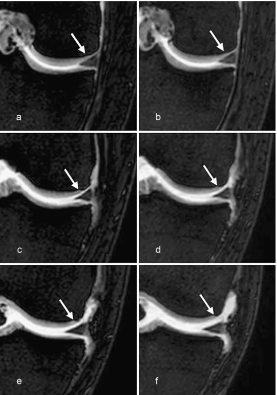 Fig. 5 Coronal T1-weighted THRIVE MR arthrograms without (a, c, e) and with (b, d, f) traction at three different levels of the medial aspect of the knee joint