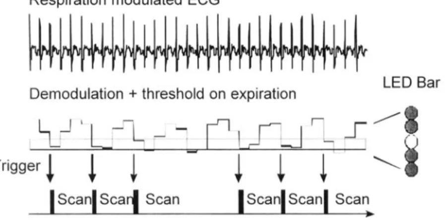 Fig.  2.  Experimental  scheme  for  combined  respiratory/cardiac  triggering  based  on  respiration-related  amplitude  variations  of  the  ECG  signal  (Scheme  C)