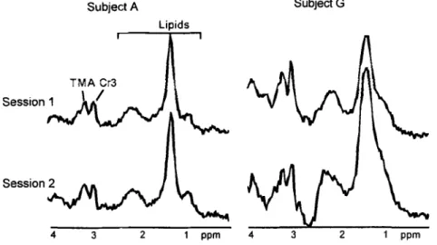 Fig.  3.  1H-MR  spectra  of the  human  heart  (septum)  recorded  with  double  triggering  (method  C)  in  two  independent  sessions  and  two  subjects