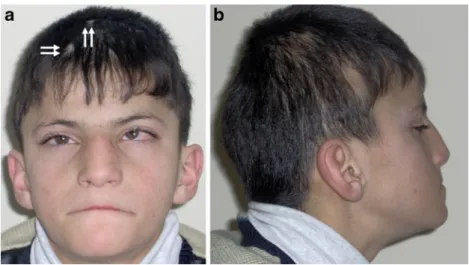 Fig. 3 Patient 4 at the age of 20 years. a Front view showing broad, high forehead, mild bilateral ptosis, and slight synophris