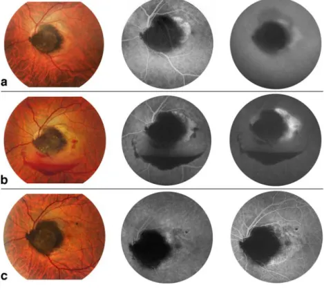 Fig. 1 a At presentation. Fundus photograph: serous retinal  detach-ment surrounded by lipid deposits overlying the choroidal  compo-nent of the tumor