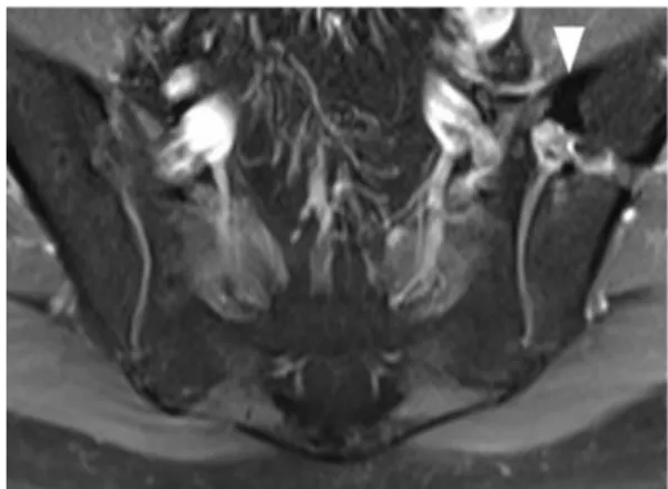 Fig. 5 Follow-up axial gadolinium-enhanced fat-suppressed T1- T1-weighted (TR/TE = 425/9) turbo spin echo MR image of the pelvis shows fusion (arrowhead) of the anterior portion of left SI joint.