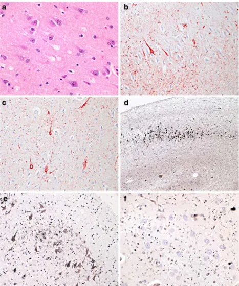 Fig. 3 a Immunohistochemistry with an antibody directed against four-repeat (4R) tau isoforms stains a “pretangle” neuron in sector CA4 in case 6